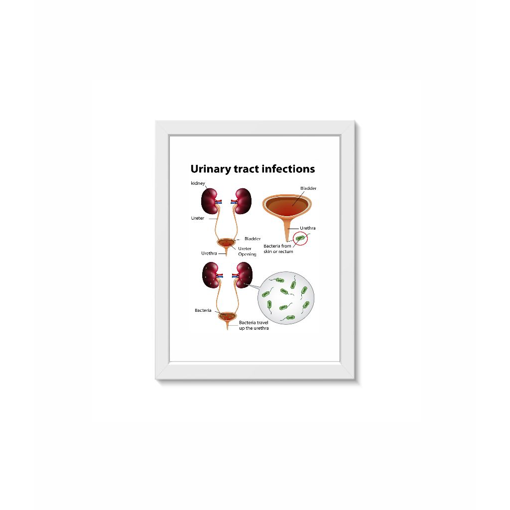 Quadro Decorativo Infecção Urinária Urologia Nefrologia Medicina Moldura 20x30cm Madeira Vidro Cor Branca