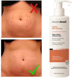 Creme Anti-Estrias - Diga Adeus às Estrias! Previne Novas Estrias & Reforça a Elasticidad…