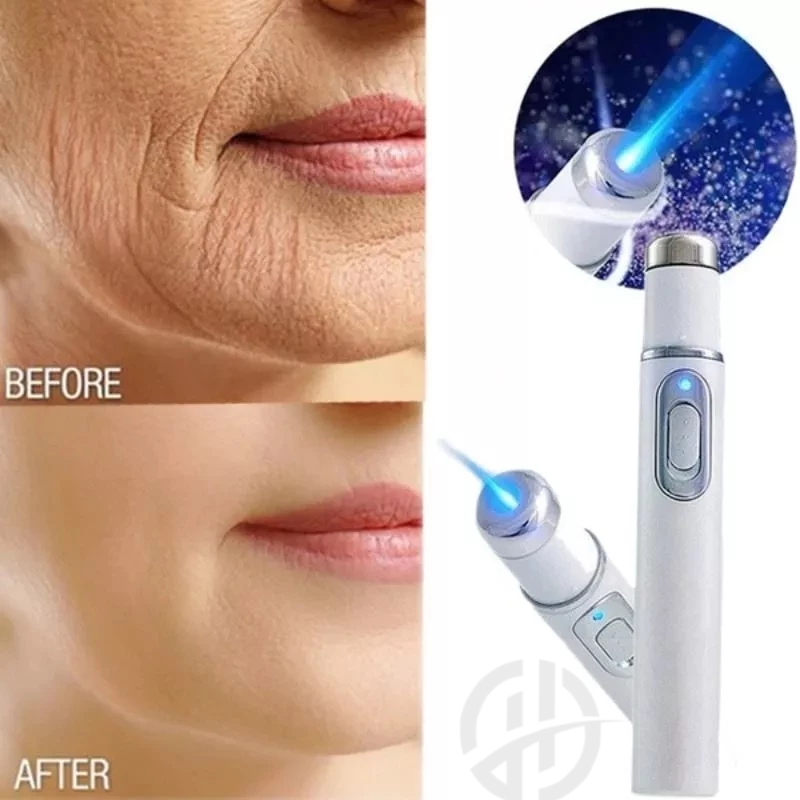 Caneta Led 45nm Luz Azul Acne Terapia Cicatriz Mancha Rugas
