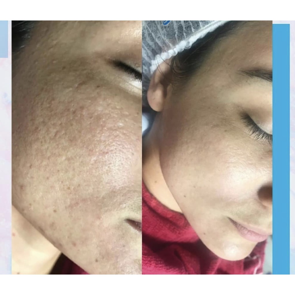 Creme De Hidroquinona Antes Depois