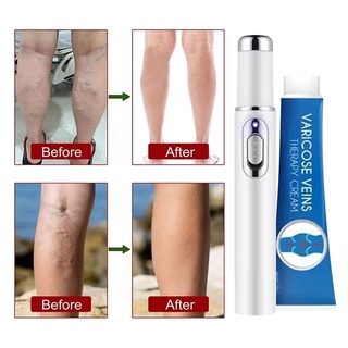 kit anti varizes vazinhos veias nas pernas creme pomada+caneta led luz azul tratamento varizes acne cicatriz