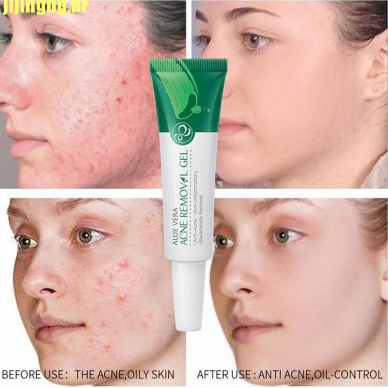 Pomada Gel Tira Manchas e Espinhas Tratamento Acne Aloe Vera | Shopee ...