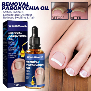 Óleo De Remoção De Paroníquia , Reparo De Unhas Encravadas , Alívio De em Oferta na Shopee