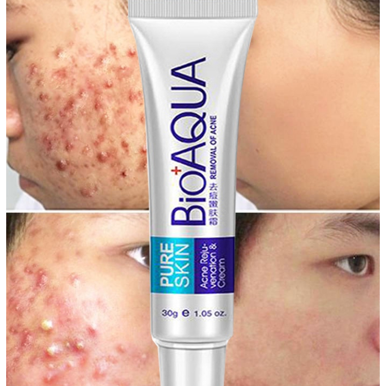 Creme Acne Bioaqua Pele Pura 30g Pele Oleosa em Oferta na Shopee