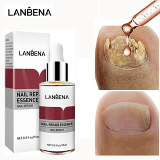 Essência Soro 15 ml Tratamento para Unhas Fungos e Micose Lanbena Natural