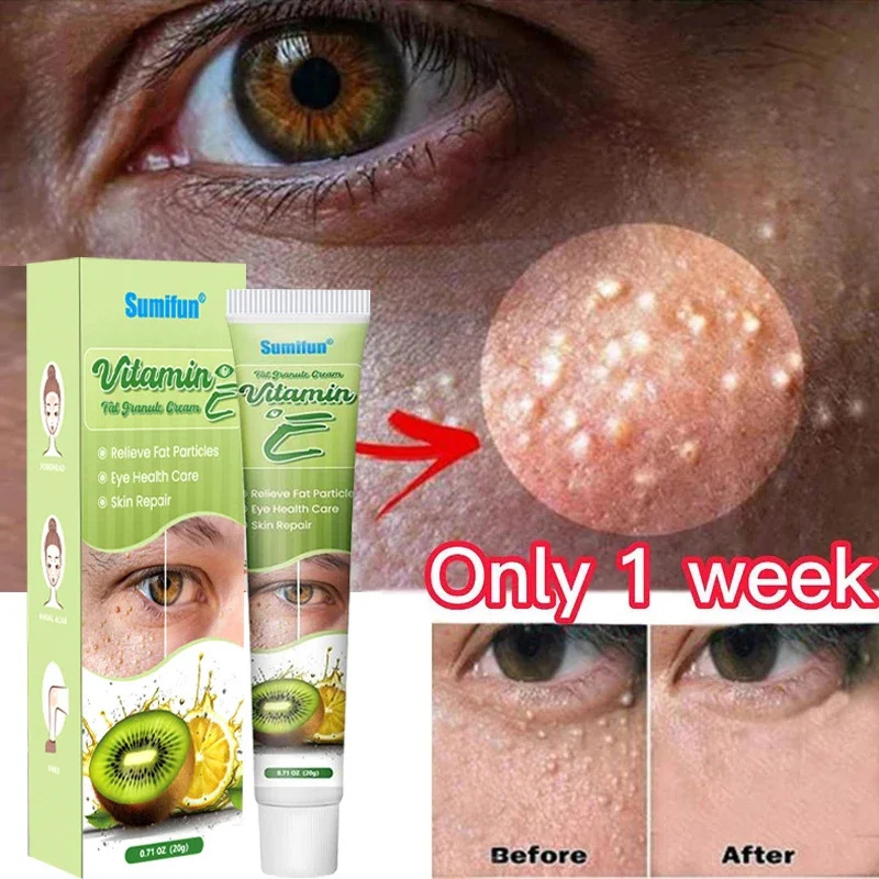 20g Vitamina E Krim Milia Removedor De Sementes Creme Para Os Olhos Grânulo De Gordura Syringoma Grãos De Graxa Cuidados