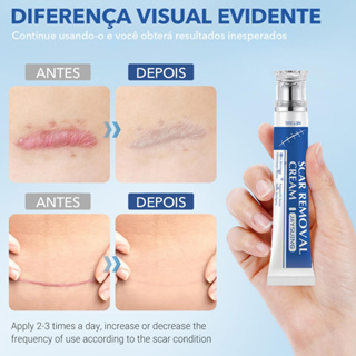 Fade Scar Repair Cream - Reduz e atenua cicatrizes de queimaduras e escaldões em Oferta na Shopee