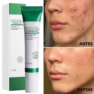 Creme De Ácido Salcyclic 20ml Para Remoção De Poros/Acne & Clareamento/Anti-Ássidade 20ml em Oferta na Shopee