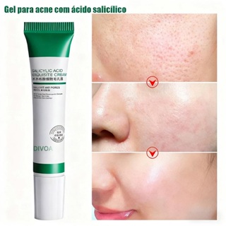 Creme de Ácido Salicílico para Redução de Poros - Loção Facial Hidratante Redução de Poros Dilatados em Oferta na Shopee