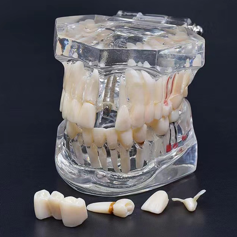 Modelo De Dentes De Doença , Implante Dentário , Ensino De Aprendizagem De Estudante em Oferta na Shopee