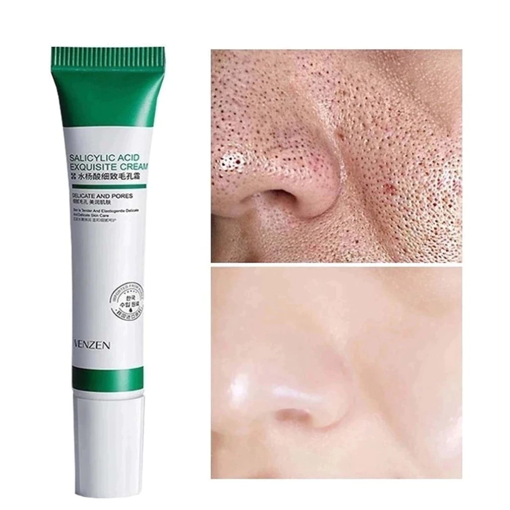Ácido Salicílico Acne Creme Remover Cravo Controle De Óleo Anti-Tratamento Reparação Espinha Cicatriz Clareamento Facial em Oferta na Shopee