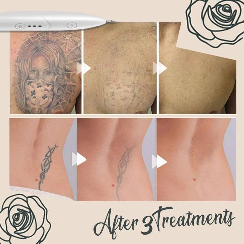 Caneta De Remocao De Tatuagem Sp Ot Instancias Sorvete Instantaneo Shopee Brasil