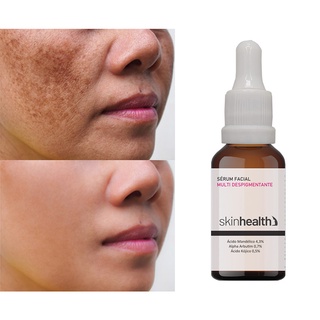 Tratamento Multi Despigmentante Para Clarear A Pele Melasma