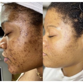 Removedor de Foliculite ( peeling corporal ) enviamos de imediato