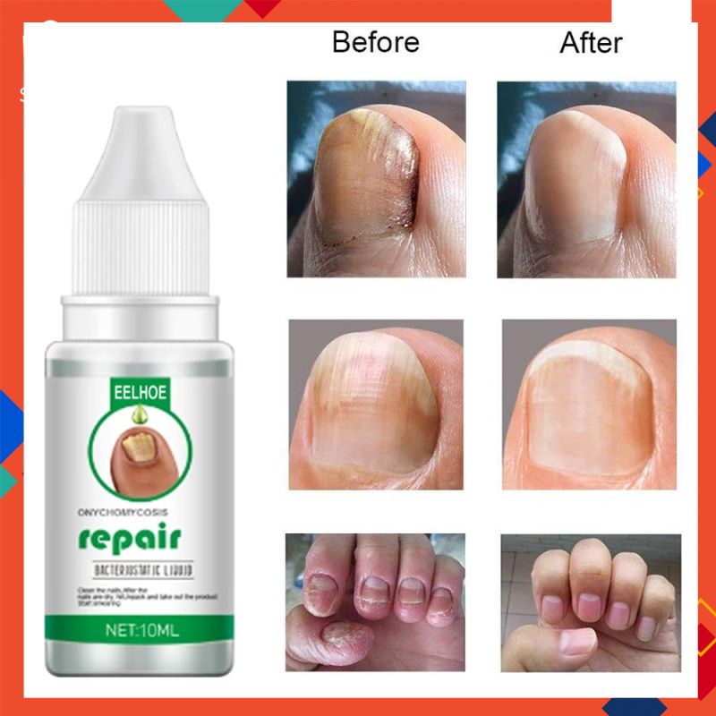Eelhoe Onychomycosis Repair Liquid Nail Treatment Liquid Thicken Soft Nails   | Shopee Brasil