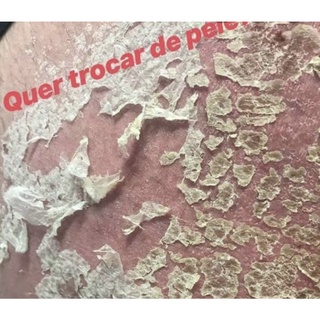 Àcido mandelico ( peeling corporal 30ml) axilas virilhas foliculite coxas de atrito