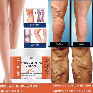 Do Diretor Cirúrgico Pomada Veia Vasculite Tratamento Blefarite Pernas rotten Vascular Creme Aranha