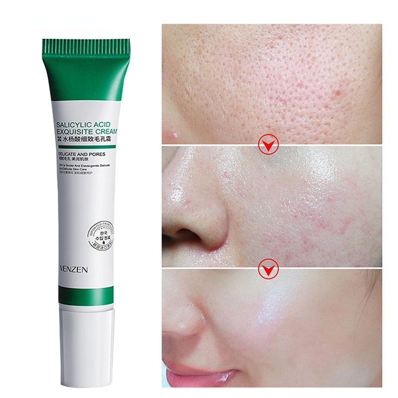 Veze Creme De Ácido Salcílico Para Remoção De Poros/Acne E Clareamento Acnes/Clareamentos/Controle De Oleosidade 20g