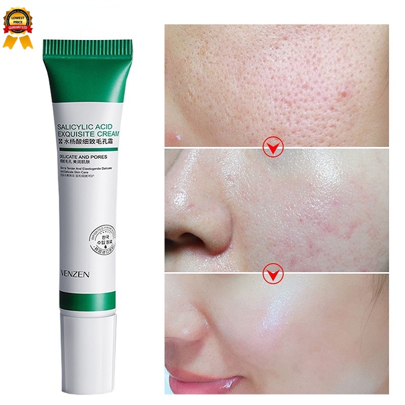 20ml De Creme De Ácido Salcílico Para Remoção De Poros/Acne E Branqueadora/Branqueamento/Antiguidade/Controle Oleoso