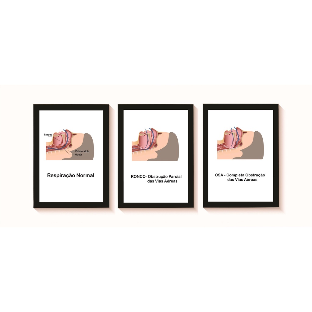Kit 3 Quadros Decorativos Apneia do Sono Decoração Consultório Otorrinolaringologia  Molduras 20x30cm Madeira