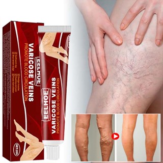 Creme De Alívio De Véias Varizes , Alivia A Vasculite Das Pernas Flebite Fadiga Veias