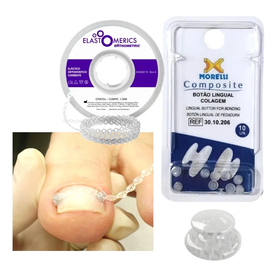 Kit estético Botão + Elastico  P/ Desencravar Unhas Podologia correção unha encravada em Oferta na Shopee