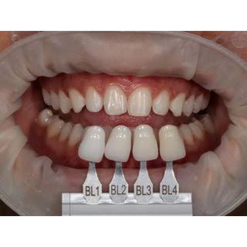 Kit 20 Dentes/facetas Postiço De Resina + massa Fixar. Bl1/B2. Provisórios.