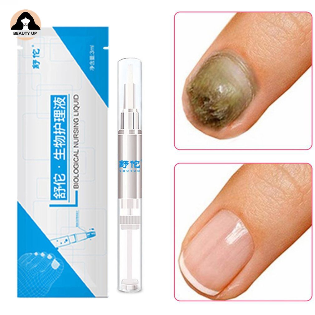 Caneta Para Unhas Onicomicose Paroníquia Infecção De Ervas Toe Health Nails em Oferta na Shopee