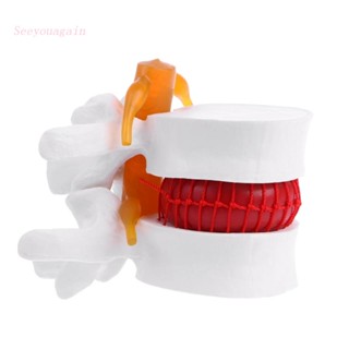 Seeyouagain Modelo Anatômico De Hérnia De Disco Lombar De Hédico Anatomia Instrume