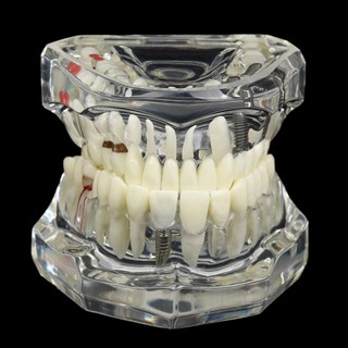 Disease Dentária Modelo De Dos Dentes Com Ponte De Restauração Dentista Para Ciência Médica Estudo De Doença