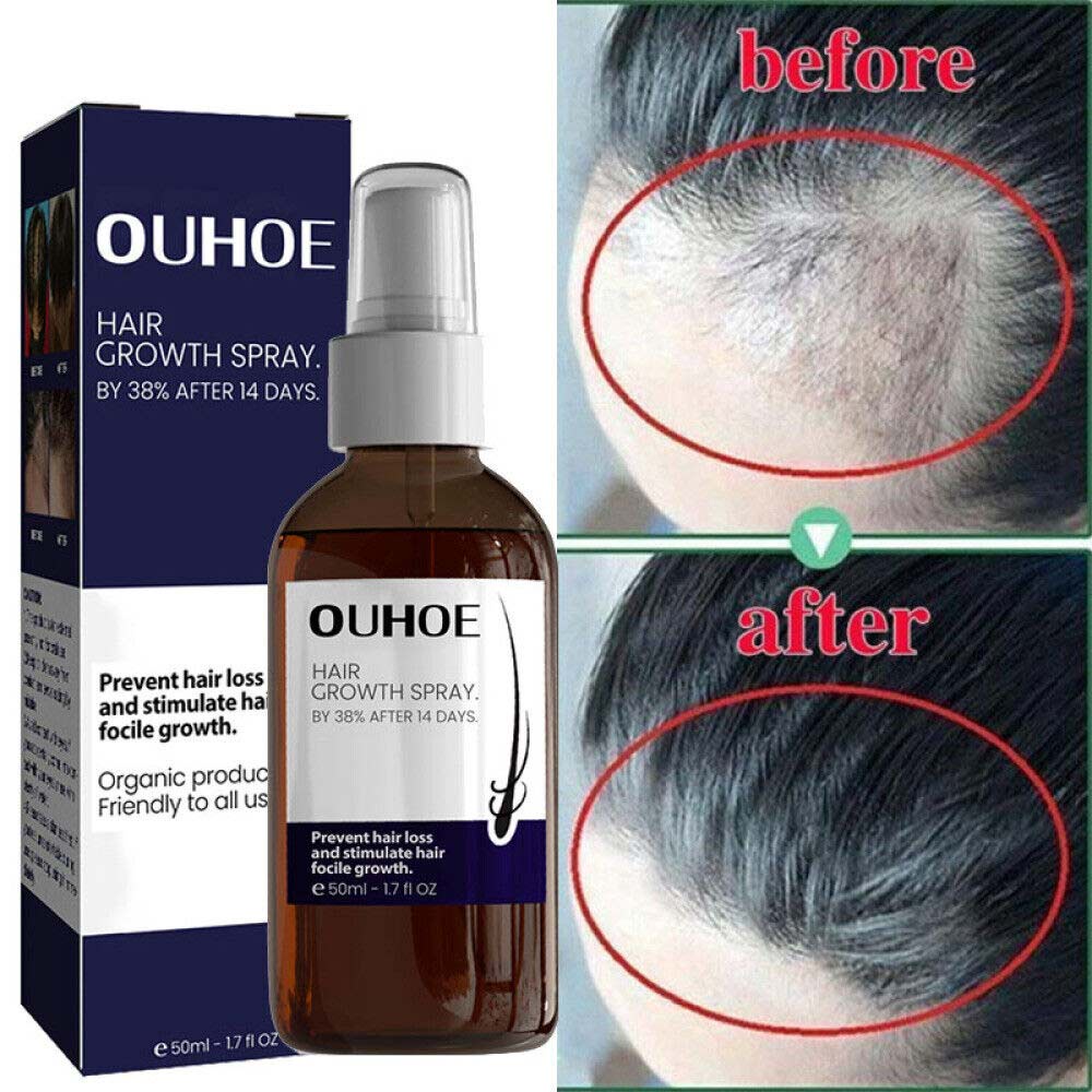 OUHOE Hair Growth Spray Nourishes Rapid Development and Prevents Hair Loss Control Treatment Serum Hair Care Hair Growth Liquid