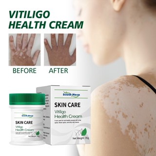 35g De Creme De Vitiligo , Tratamento Para Pele Reduzir Pontos Brancos E Melhorar A Pigmentação Da