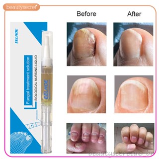 Eelhoe 3ML Caneta Tratamento de Fungos Nas Unhas Onicomicose Paroníquia Anti Infecção Fúngica das Unhas Chineses À Base de Plantas ↑ beauty6 -beauty