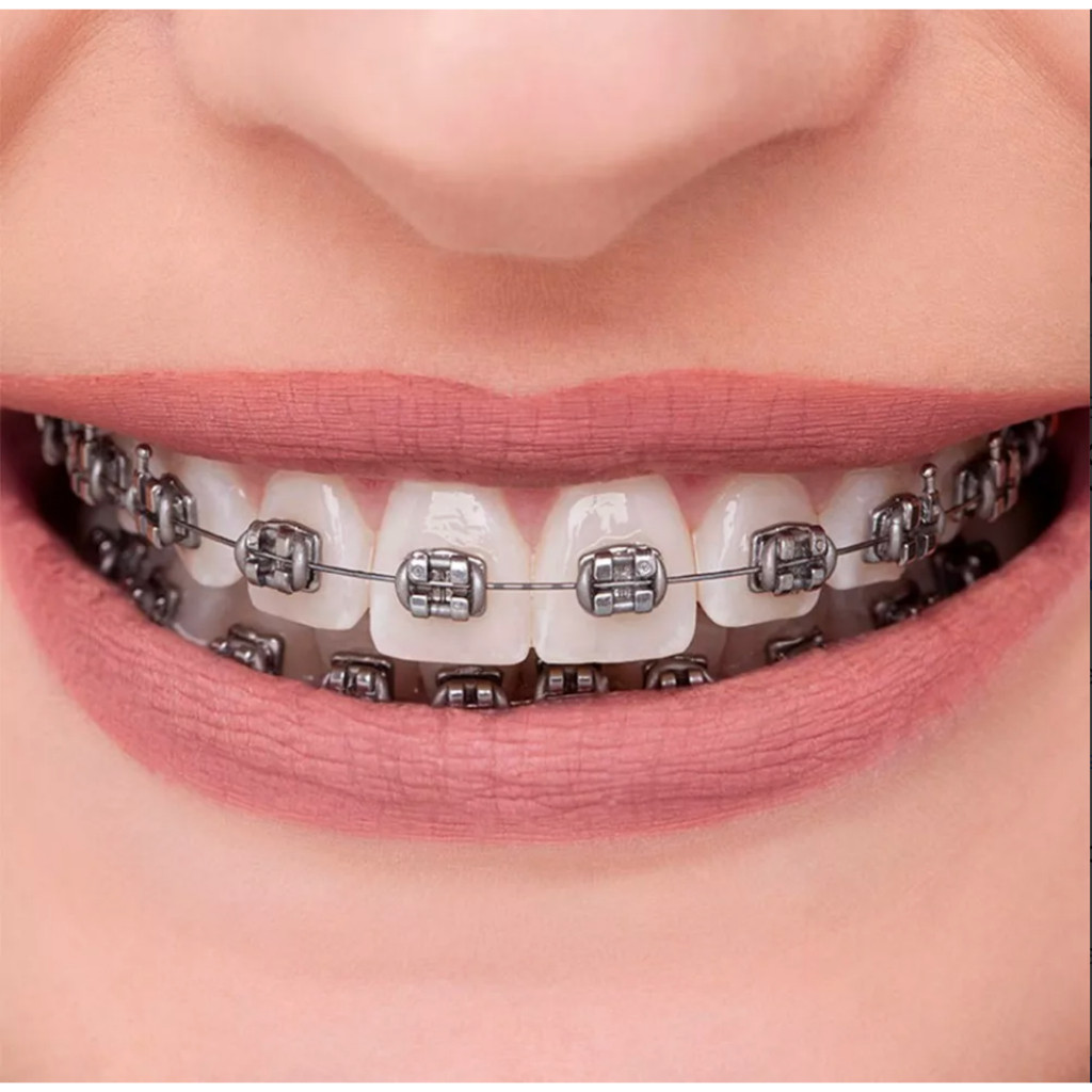 Boca De Aparelho / Braquetes Ortodônticos Metal Aparelho Fixo de Metal em Oferta na Shopee
