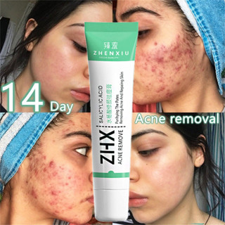 Creme para Acne, Creme para Cicatrizes, Tratamento para Acne, Gel para Tratamento de Manchas de Acne, Creme para Espinha em Oferta na Shopee