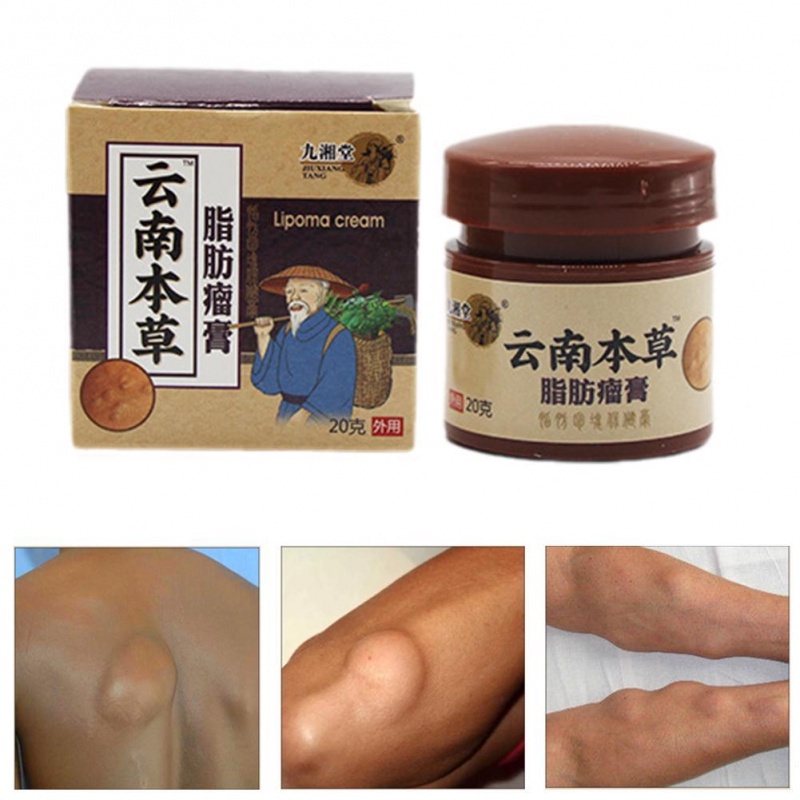 1pcs 20g creme da remoção do Lipoma/poço-polegada Opomment para a esfoliação da pele