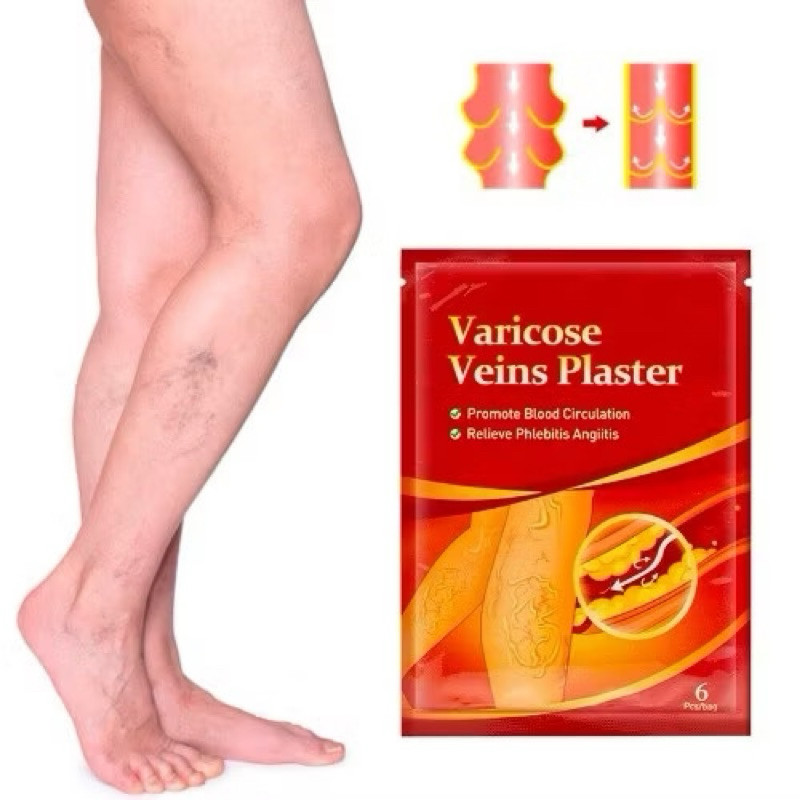 Kit Adesivo Auxilia Nas Varizes Vasos E Veias Auxiliando na Saúde das Pernas em Oferta na Shopee