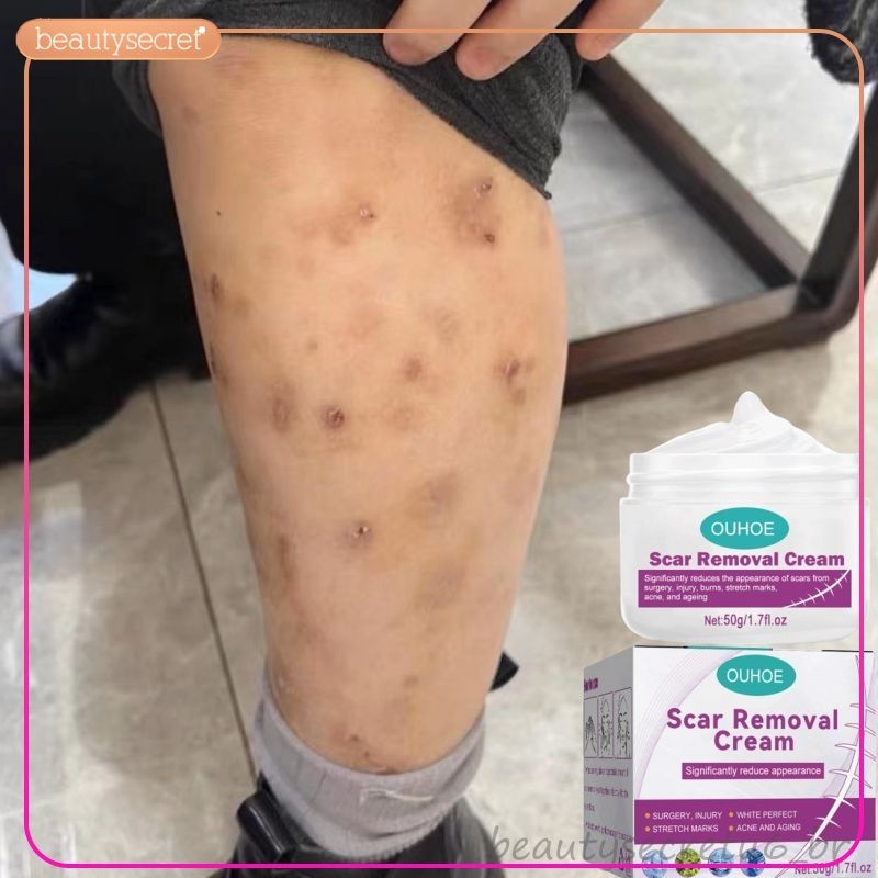 Creme Corporal Renovador | Suaviza a Aparência de Marcas Antigas, Cicatrizes, Manchas e Imperfeições da Pele