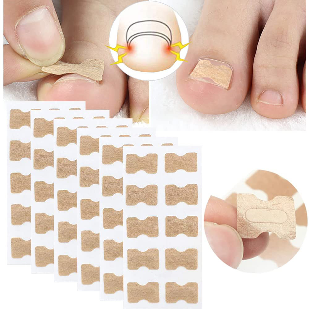 50/150pcs Corretor De Unha Encravada Adesivos De Correção Paronychia Ferramenta Pedicure