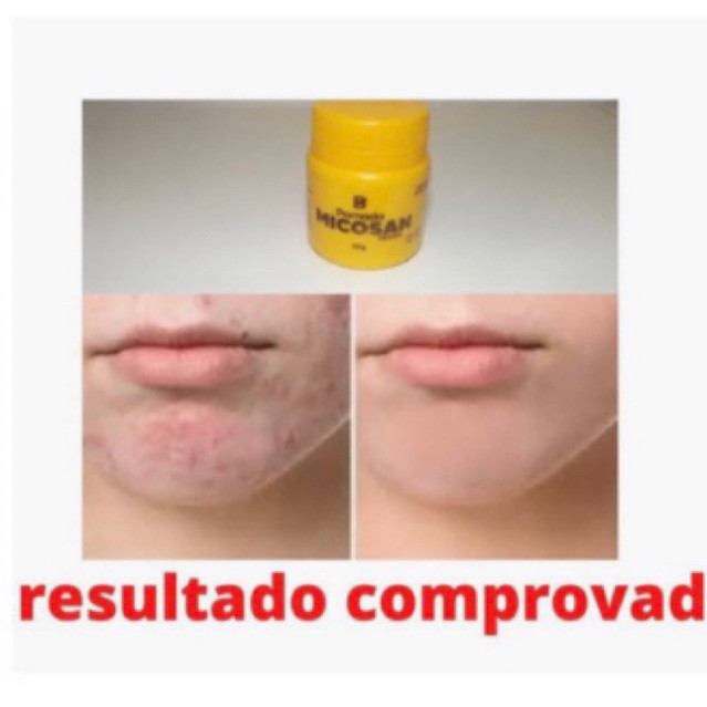 Pomada Micosan Clareador Micosan Kit 2 Pomadas