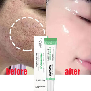 Creme De Ácido Salicílico Para Encolhimento De Poros Apertar O Rosto Produto De Cuidados Com A Pele Lisa Coreana em Oferta na Shopee