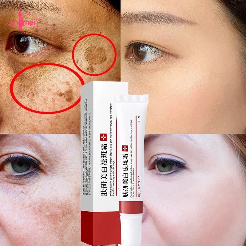 Creme Branqueador Para Remover Melasma Manchas Escuras , Melanina , Pele Brilhante