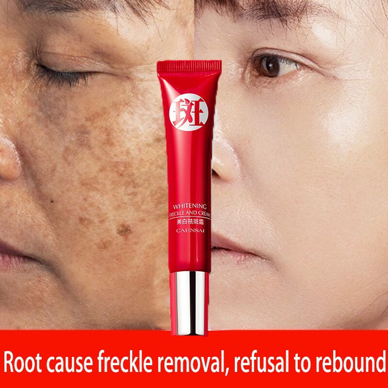 Creme forte original para remover manchas escuras/clareamento pigmentado/cuidados com a pele QRJZ VQGA