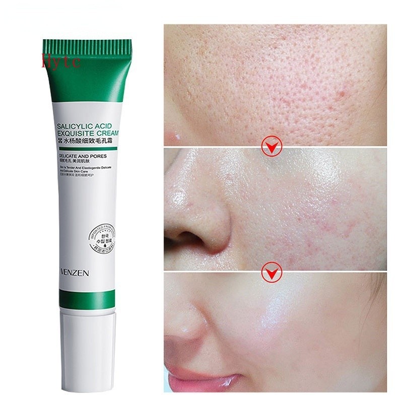 Creme/acne ácidos Salcylic da remoção do Poro 20ml e acnes do alvejante/clareamento/antienvelhecimento/controle oleoso