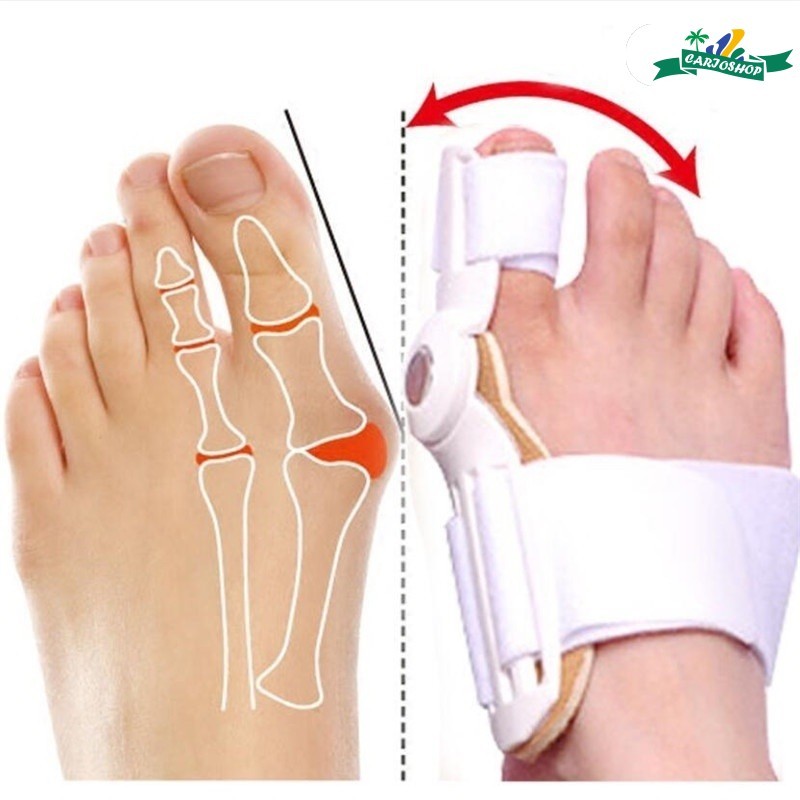 Órtese Noturna para Correção de Joanetes - Articulada e Ergonômica