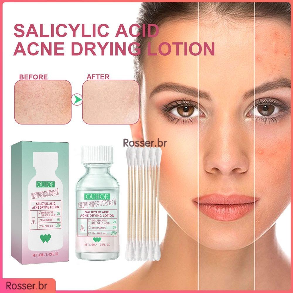 Loção para reparação de acne Loção para minimizar poros Cuidados faciais leves Loção para acne com ácido salicílico Melhora a textura da pele Produtos para cuidados com a pele Loção para acne (Rosser.br)