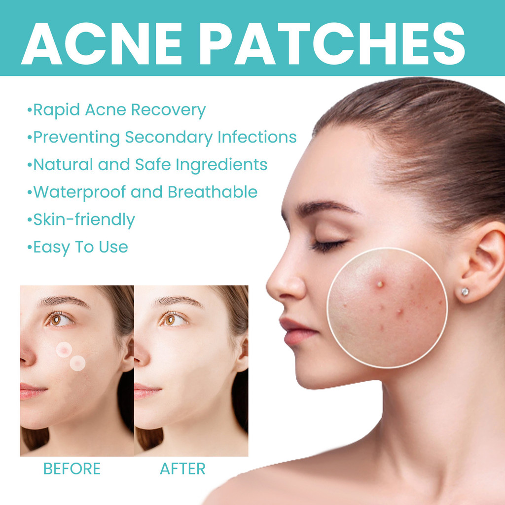 Patch de Acne Reparo Acne Acne Acne Poros de Limpeza Acne Invisível Respirável à prova d'água Patch de Limpeza Acne