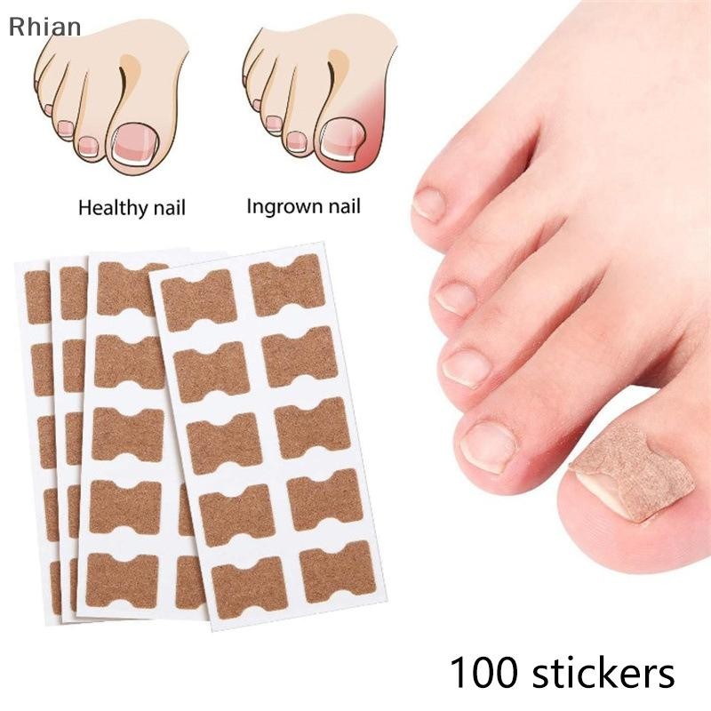[Rhian] 100 Unidades Adesivo Para Fungos Nas Unhas Reparo De Correção Encravada Cuidados Com As Paroníquia Remendo COD em Oferta na Shopee