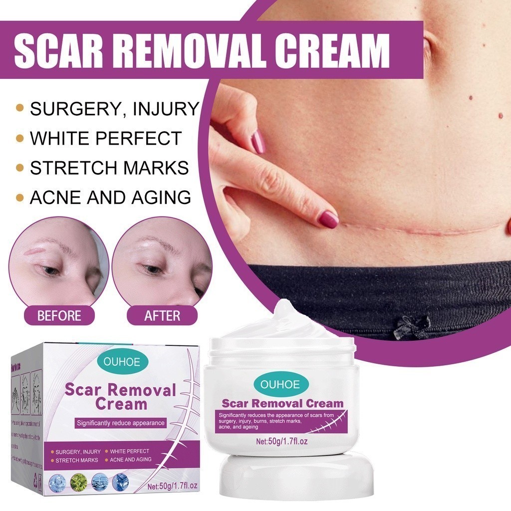 Creme Eliminar Cicatrizes Pretas Remover Feridas Antigas Picada de Mosquito Cicatriz Quelóide Queimaduras Scal -beleza em Oferta na Shopee