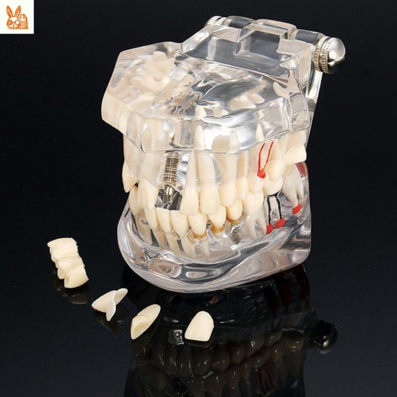 Modelo Dental de Dissecção com Restauração de Ponte para Dentista, Ferramenta de Ensino de Dissecção para Ciência da Med